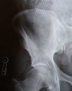 Right Hip.jpg